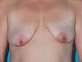 Patient # 34162 Before Photo # 1