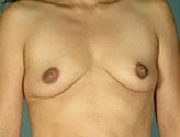 Patient # 19484 Before Photo # 1