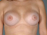 Patient # 35423 After Photo # 2