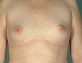 Patient # 35423 Before Photo # 1