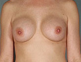 Patient # 67890 After Photo # 2