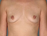 Patient # 67890 Before Photo # 1