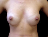 Patient # 55174 After Photo # 2