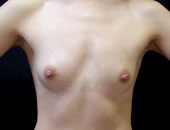 Patient # 55174 Before Photo # 1