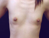 Patient # 16485 Before Photo # 1