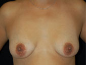 Patient # 53900 Before Photo # 1