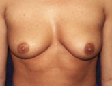 Patient # 19503 Before Photo # 1