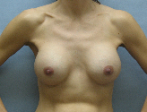 Patient # 73547 After Photo # 2
