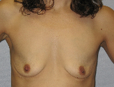 Patient # 73547 Before Photo # 1
