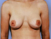 Patient # 81151 After Photo # 2