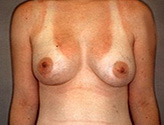 Patient # 90822 After Photo # 2