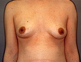 Patient # 90822 Before Photo # 1