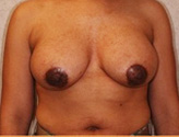 Patient # 51886 After Photo # 2