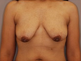 Patient # 51886 Before Photo # 1