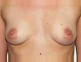 Patient # 49328 Before Photo # 1