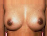 Patient # 25846 After Photo # 2