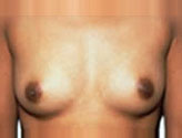Patient # 25846 Before Photo # 1