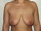 Patient # 43127 Before Photo # 1