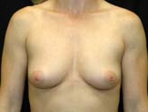 Patient # 13634 Before Photo # 1