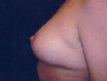 Patient # 76701 After Photo # 4