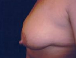 Patient # 76701 Before Photo # 3