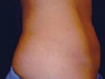 Patient # 32427 After Photo # 4