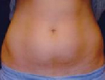 Patient # 32427 Before Photo # 1
