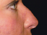 Patient # 89910 Before Photo # 1