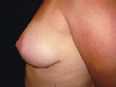 Patient # 59112 After Photo # 4