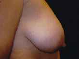Patient # 59112 Before Photo # 1
