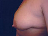 Patient # 98186 Before Photo # 1