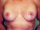 Patient # 23376 After Photo # 2