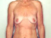 Patient # 23376 Before Photo # 1