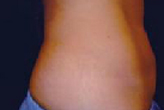 Patient # 91378 After Photo # 2