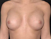 Patient # 47695 After Photo # 2