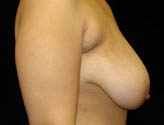 Patient # 61267 Before Photo # 5
