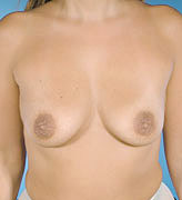 Patient # 56120 Before Photo # 1