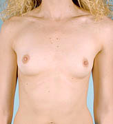 Patient # 87196 Before Photo # 1