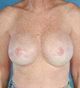 Patient # 58775 After Photo # 2