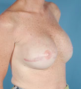 Patient # 58775 After Photo # 4