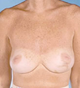 Patient # 58775 Before Photo # 1
