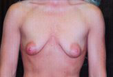 Patient # 58265 Before Photo # 1