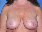 Patient # 51739 After Photo # 2