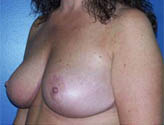 Patient # 51739 After Photo # 4