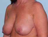 Patient # 51739 Before Photo # 3