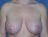 Patient # 42215 After Photo # 2