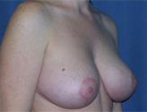 Patient # 42215 After Photo # 4