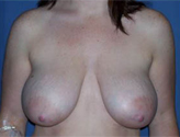 Patient # 42215 Before Photo # 1
