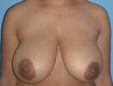 Patient # 57369 Before Photo # 1