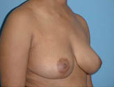 Patient # 13841 After Photo # 2